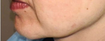 Before-menface