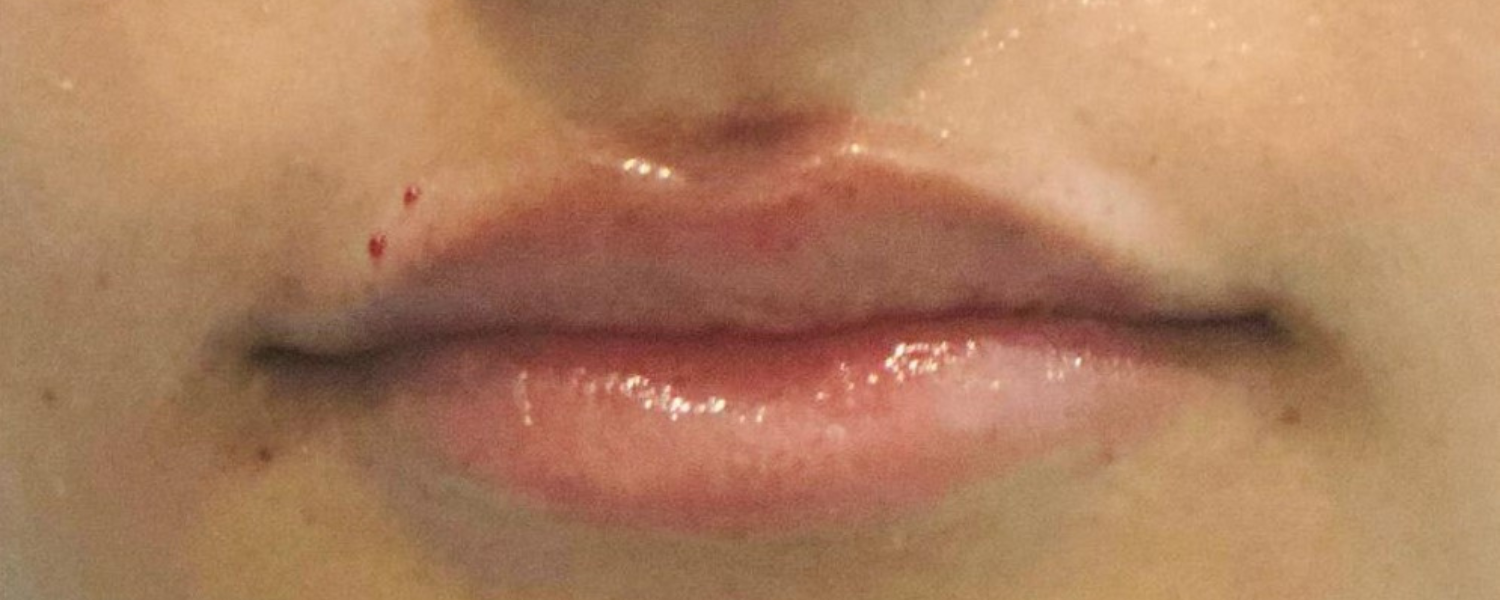 After-Lip Fillers