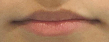 Before-