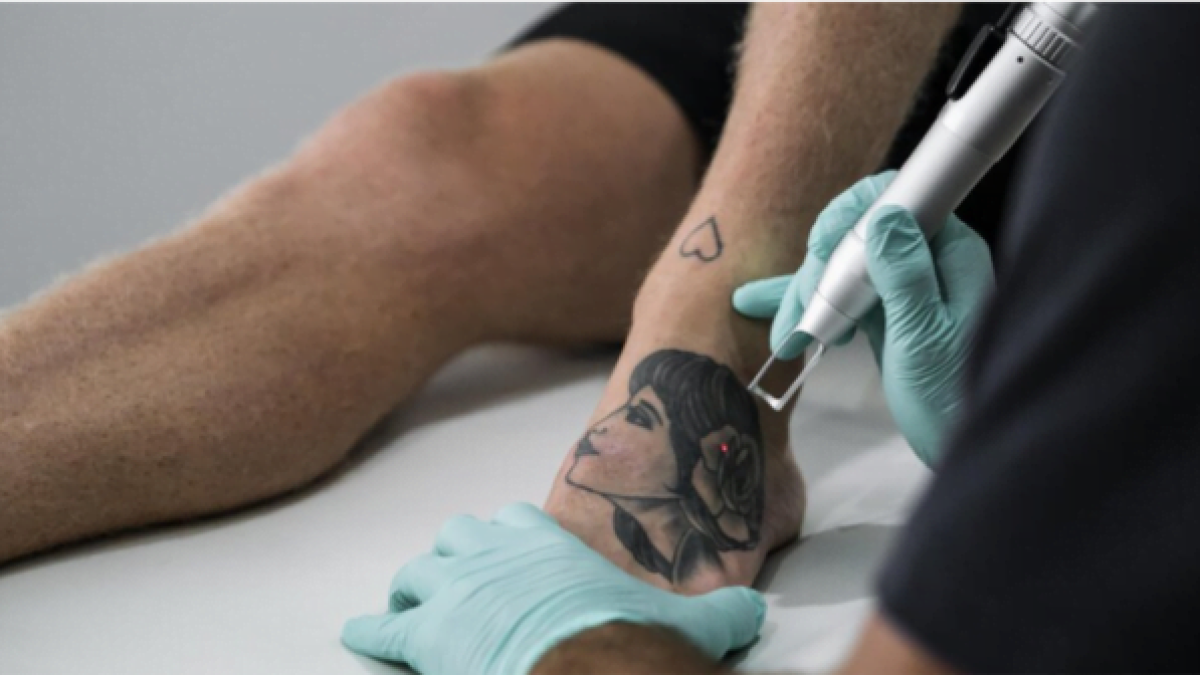 Best Laser Tattoo Removal in Islamabad | Dr Afsheen Bilal