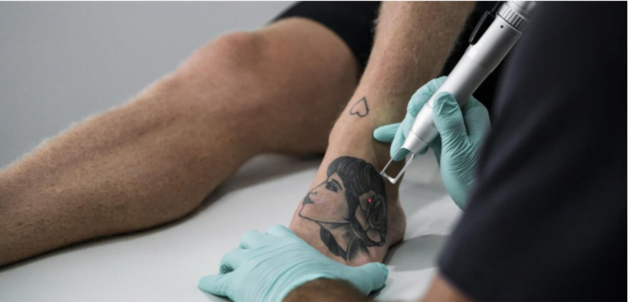 Best Pico Laser for Tattoo Removal in Islamabad