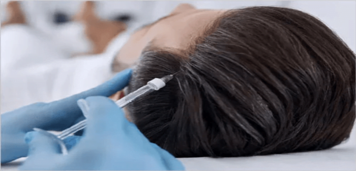 Best Exosomes Therapy for Hair Loss in Islamabad