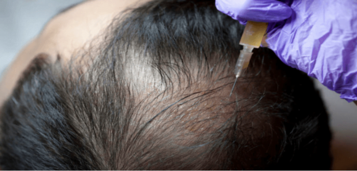 Best Hair PRP Treatment in Islamabad