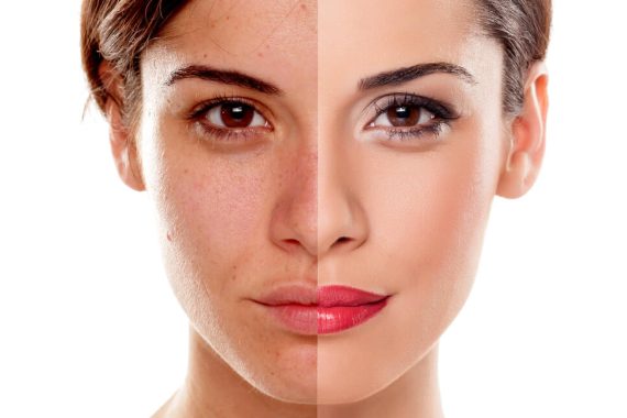 How Soon Would My Skin Get Lightened After Skin Whitening Treatment