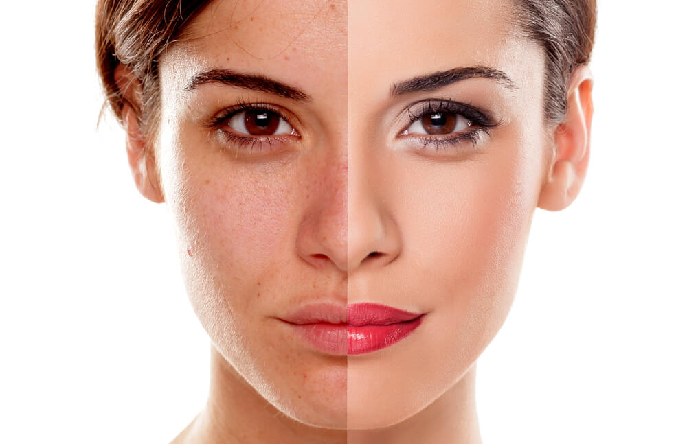 How Soon Would My Skin Get Lightened After Skin Whitening Treatment?