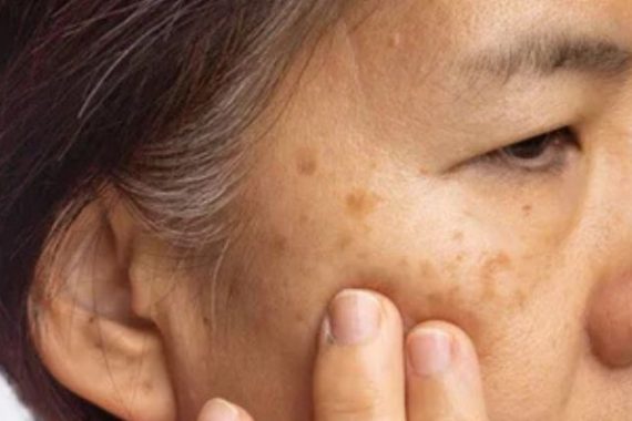 how to cure melasma from the inside