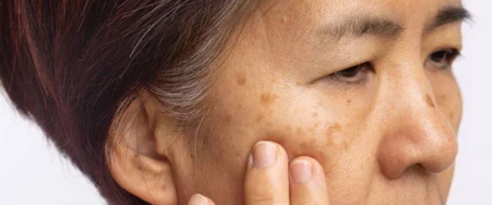 how to cure melasma from the inside