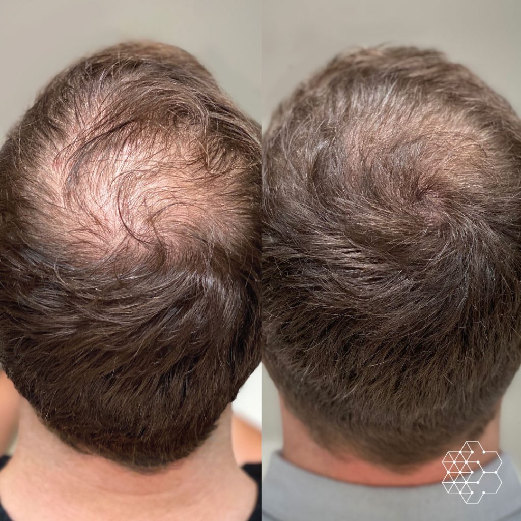 Hair Transplant in Islamabad