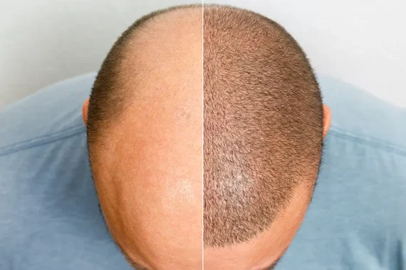 Hair Transplant in Islamabad