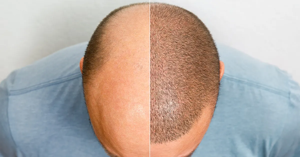 Hair Transplant in Islamabad