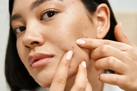Affordable-Safe-Acne-Scar-Treatment-in-Rawalpindi