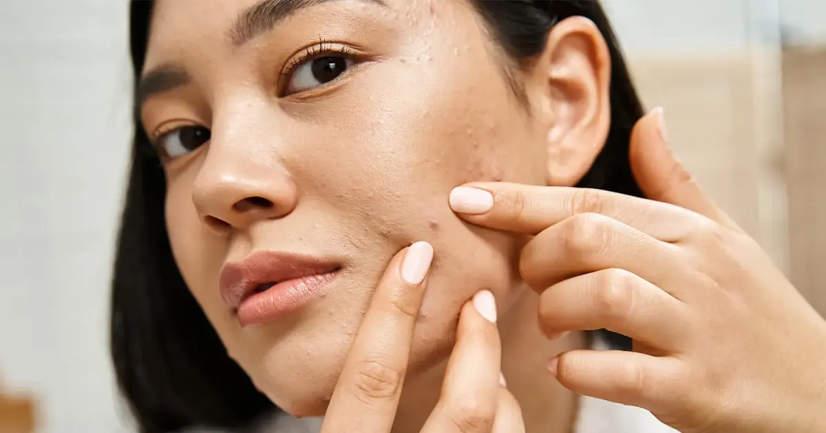 Affordable-Safe-Acne-Scar-Treatment-in-Rawalpindi