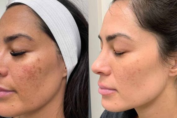 Home Remedies For Melasma in Pakistan Fail