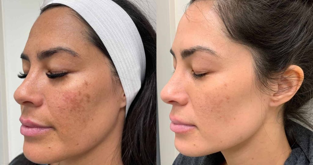 Home Remedies For Melasma in Pakistan Fail