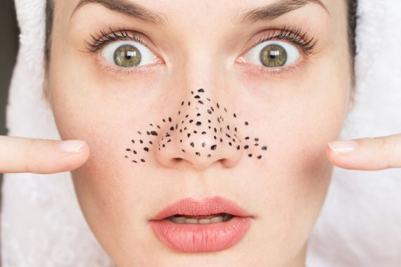 Blackhead Removal Treatment in Islamabad