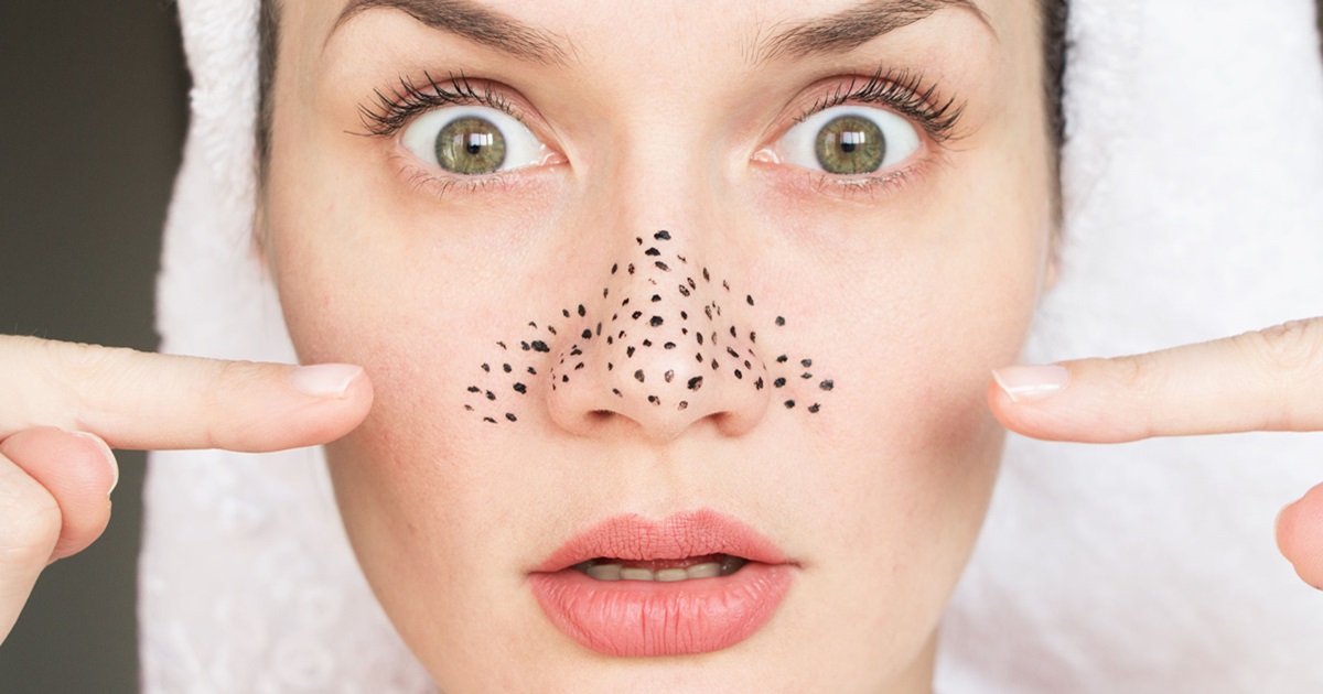 Blackhead Removal Treatment in Islamabad