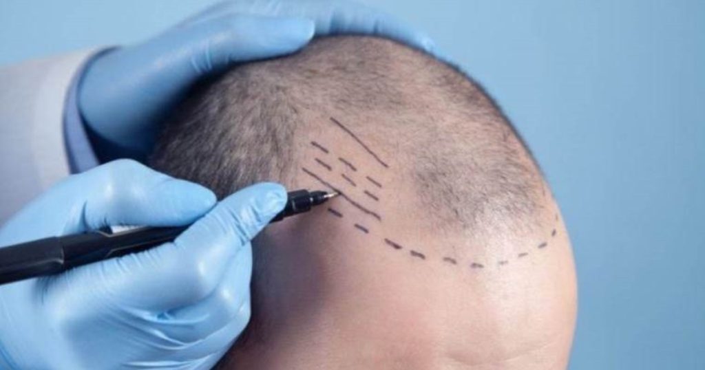 Celebrities Who Done Hair Transplant