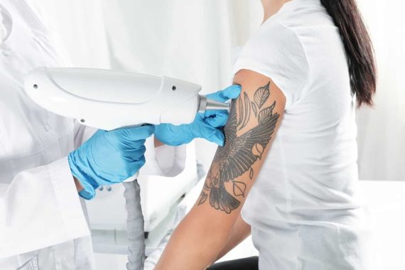 How Effective Is Tattoo Removal?