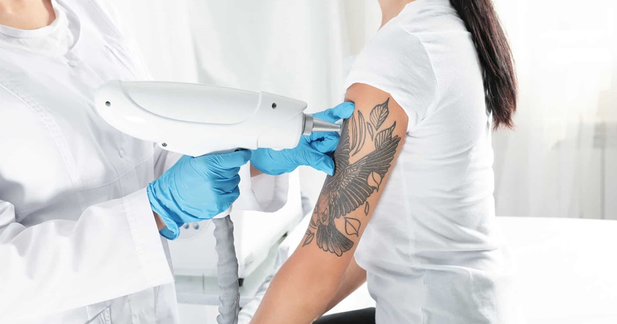 How Effective Is Tattoo Removal?