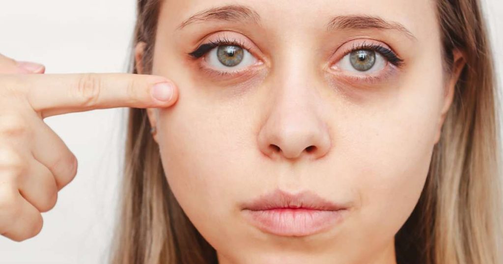 How to Avoid Dark Circles?