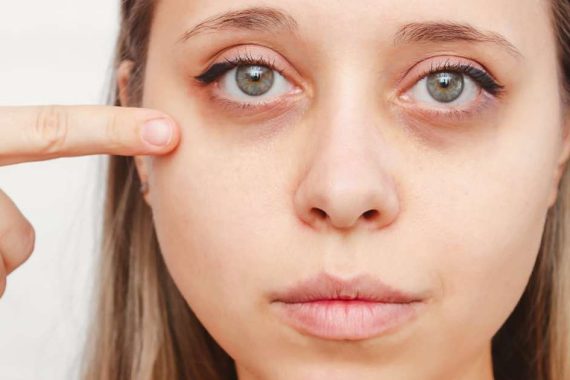 How to Avoid Dark Circles?