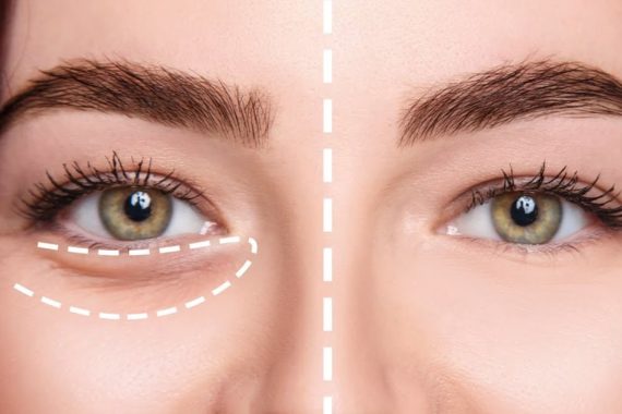 How to Remove Eye Bags Permanently