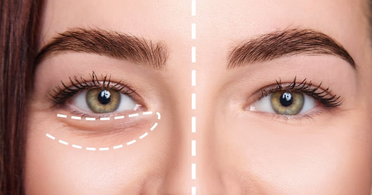 How to Remove Eye Bags Permanently