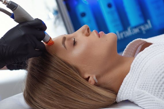 HydraFacial for acne prone skin