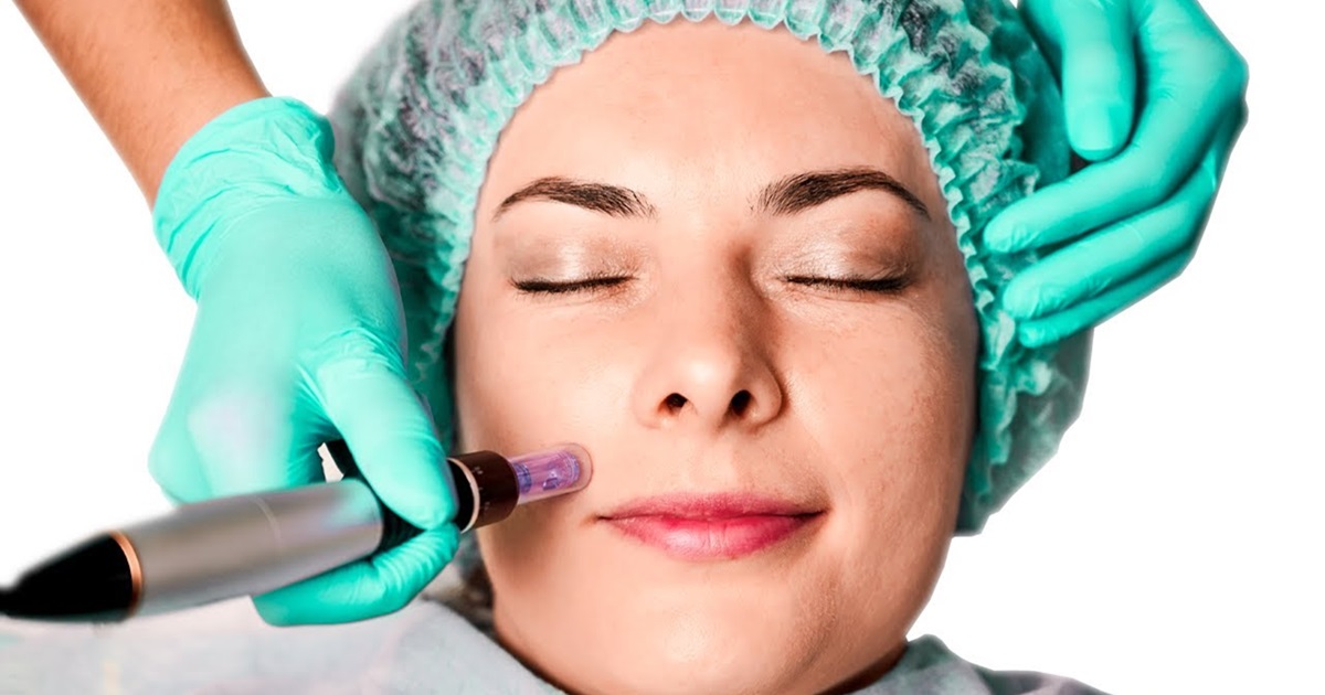 The Amazing Benefits of Microneedling for Your Face