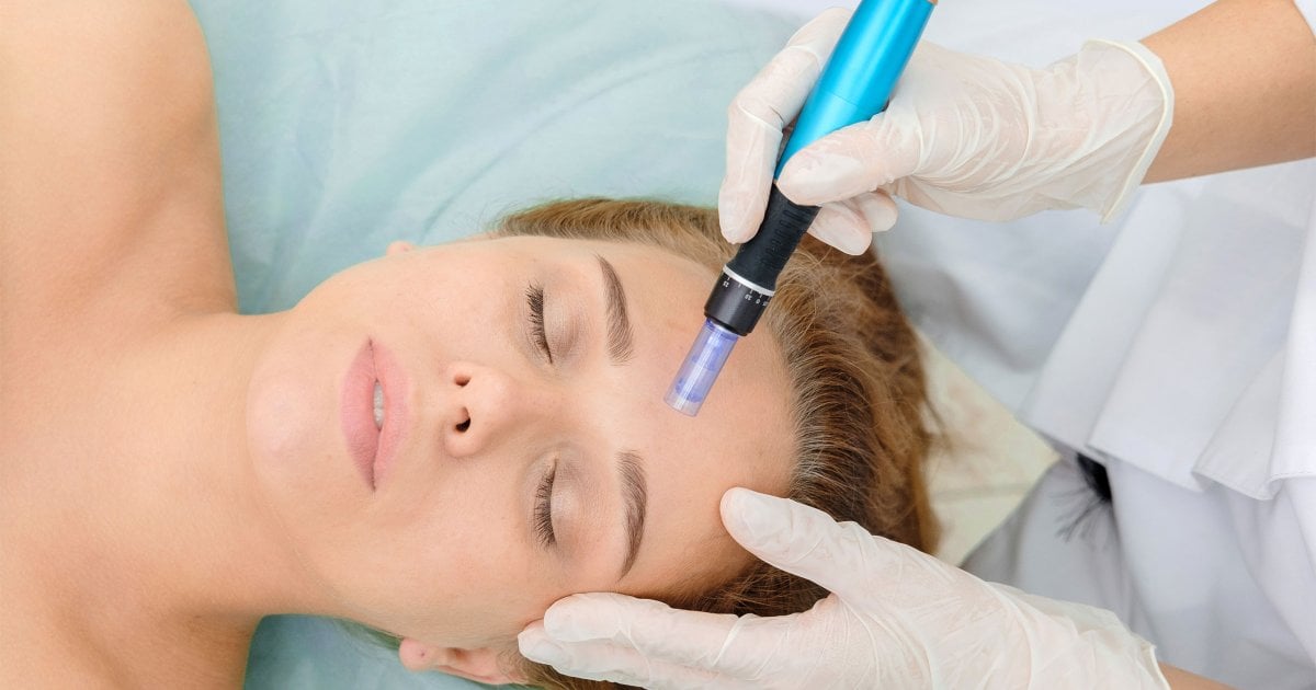 Benefits of Microneedling for Scars