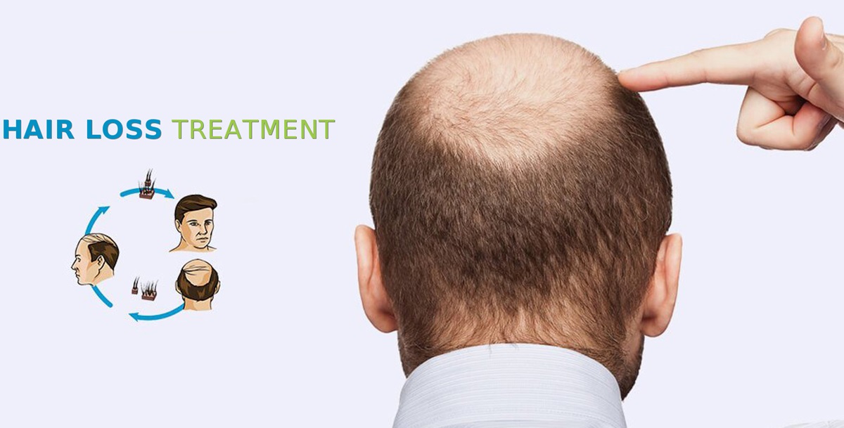 Which Season is Best for Hair Transplant