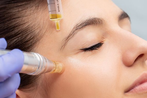 how long do microneedling results last?