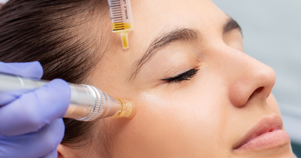 how long do microneedling results last?