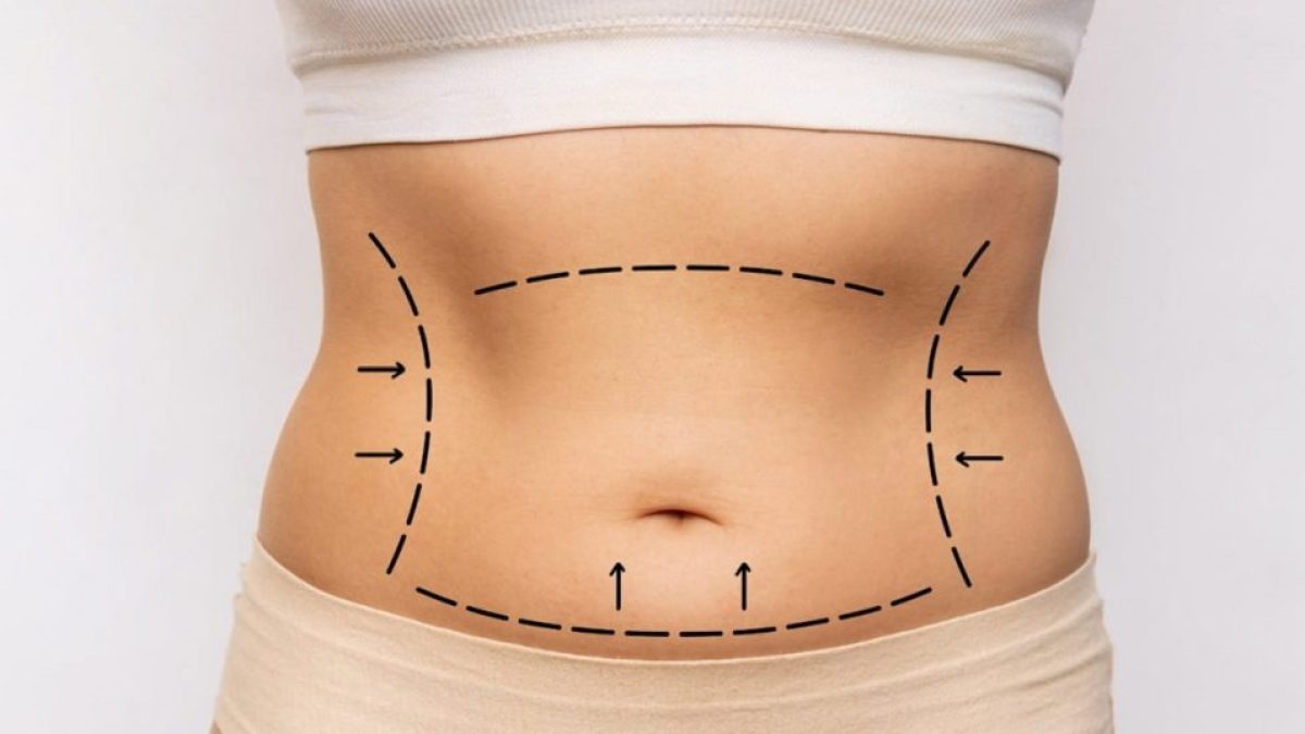 Best Tummy Tuck in Islamabad, Pakistan - Dr Afsheen Bilal