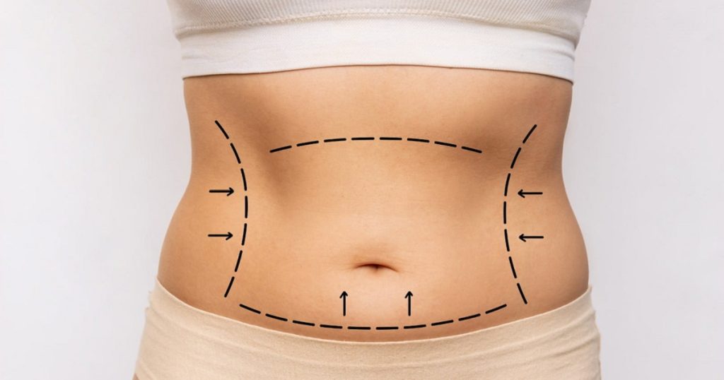 tummy tuck in Islamabad