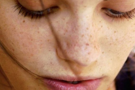 Best Treatment to Remove Dark Spots on Face