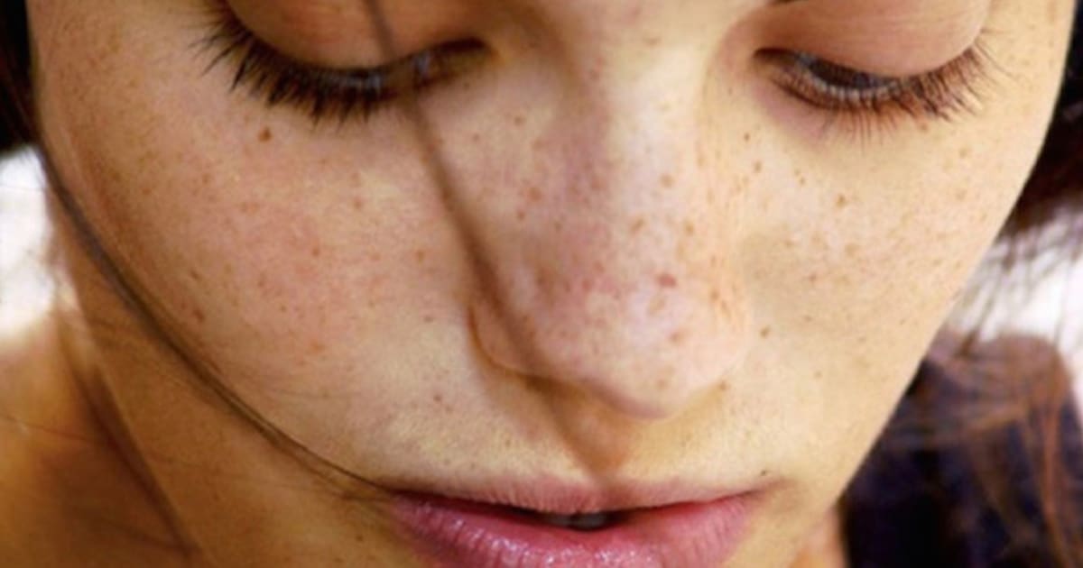 Best Treatment to Remove Dark Spots on Face