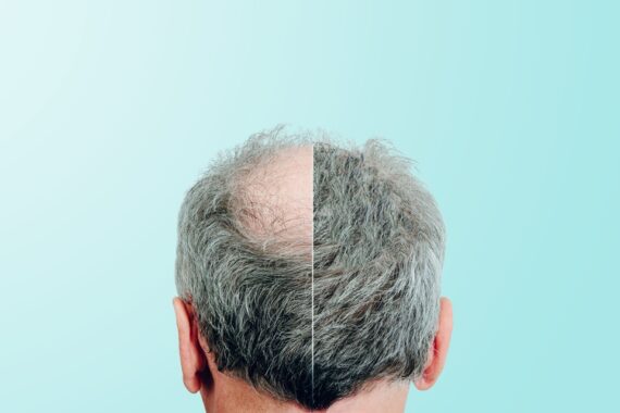 Can You Lose Transplanted Hair
