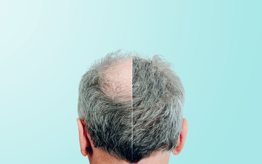Can You Lose Transplanted Hair