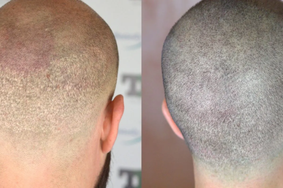 Does Hair Grow Back in the Donor Area