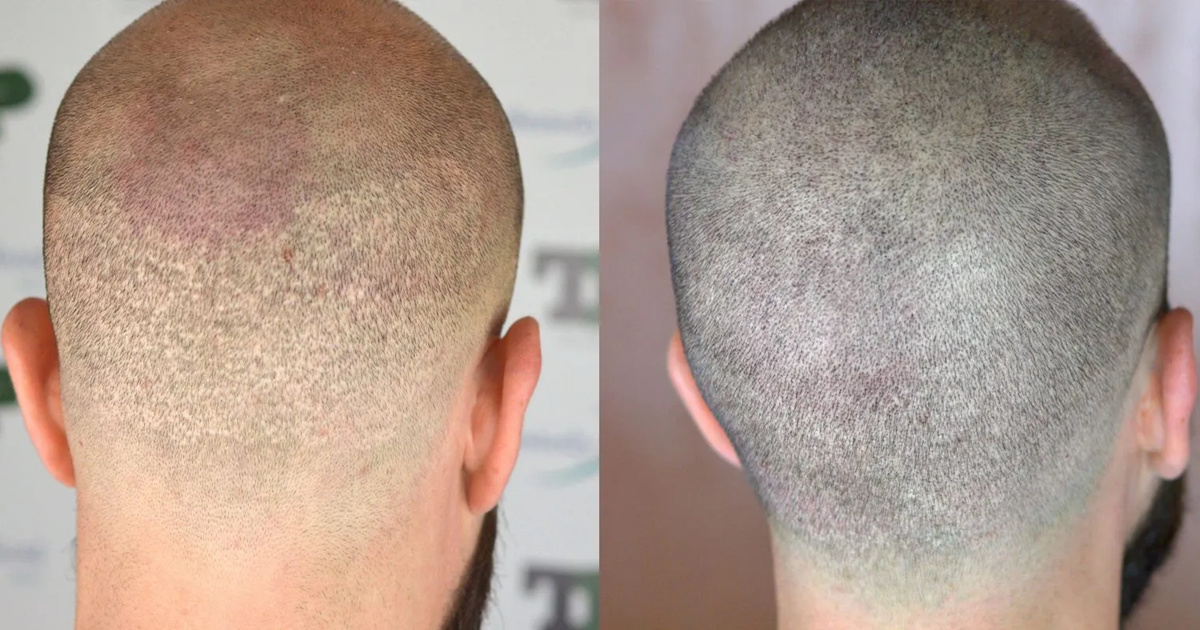 Does Hair Grow Back in the Donor Area