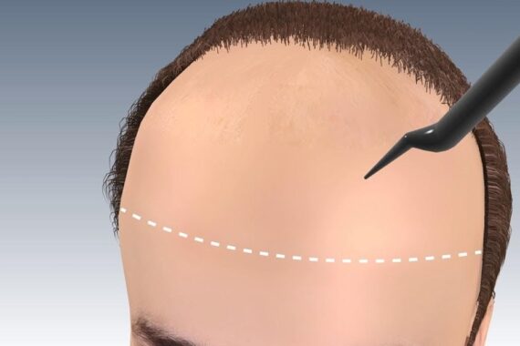 Hair Transplant for Forehead Reduction