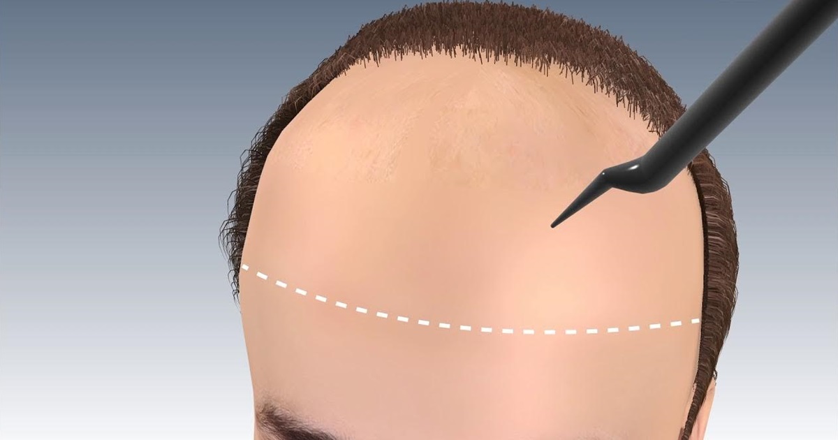 Hair Transplant for Forehead Reduction