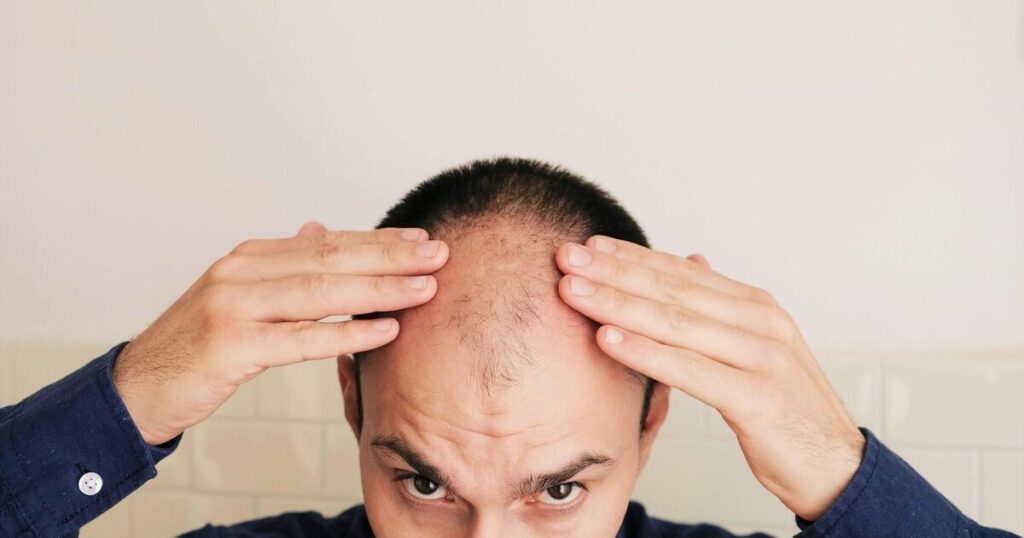 Hair Transplant for Male Pattern Baldness