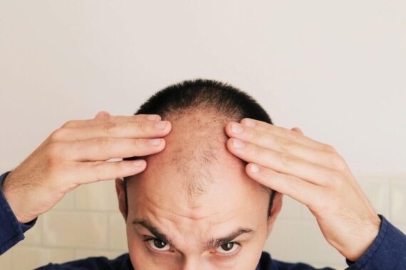 Hair Transplant for Male Pattern Baldness
