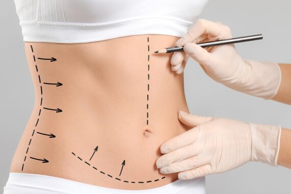 Liposuction for Women in Islamabad