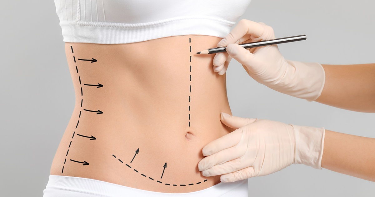 Liposuction for Women in Islamabad