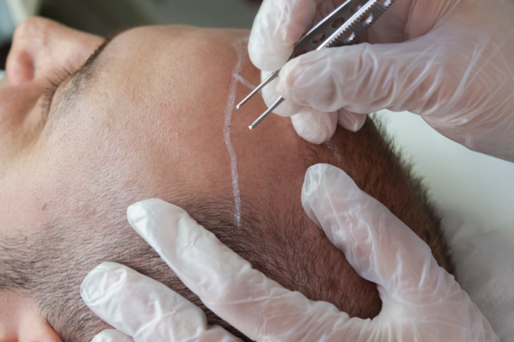 Pros and Cons of Follicular Unit Extraction