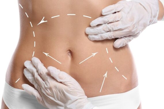 A Complete Guide to Liposuction Surgery