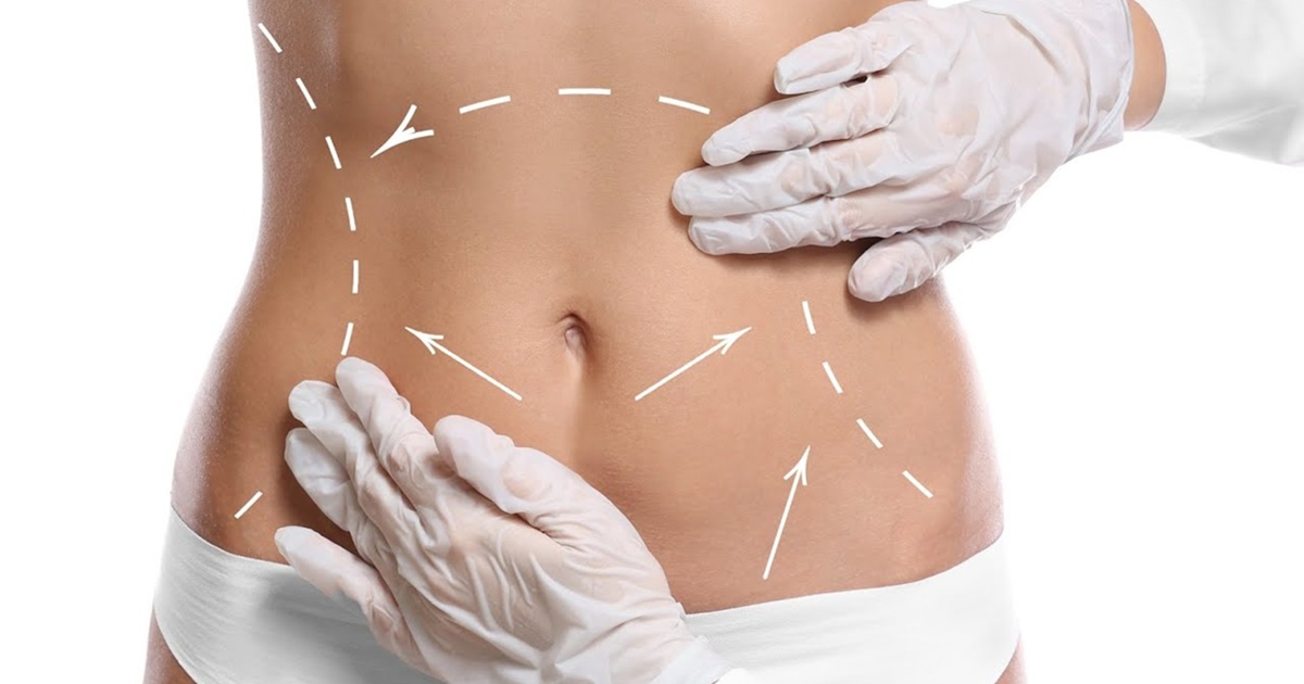 A Complete Guide to Liposuction Surgery